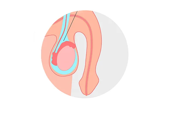Medical illustration of a hydrocele, with fluid collected in the sac around the testis