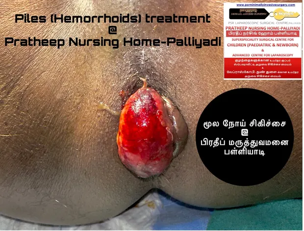 Clinical images relating to haemorrhoid treatment