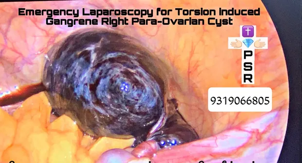 Operative photograph from an emergency cyst removal procedure
