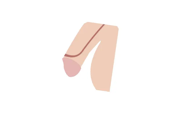 Medical illustration showing the urinary opening on the upper surface of the penis in epispadias