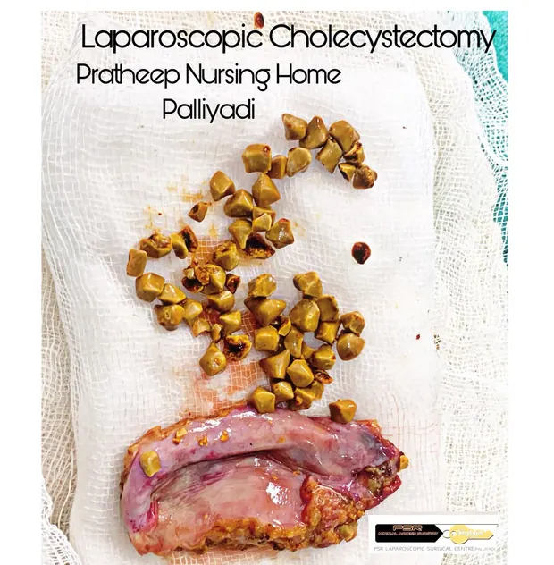 Gallstones and the removed gallbladder on surgical gauze after a laparoscopic cholecystectomy