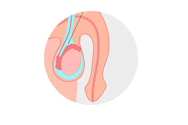 Medical illustration of a hydrocele, with fluid collected in the sac around the testis