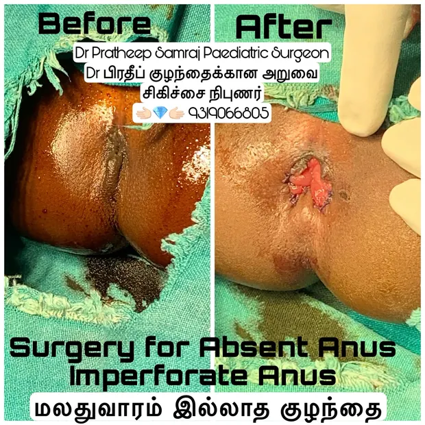 Clinical images relating to surgery for imperforate anus in children