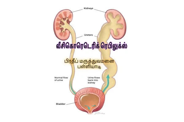 Diagram of vesicoureteral reflux, with urine flowing back from the bladder up the ureter to the kidney